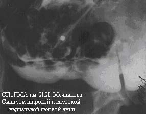 герниограмма синдром широкой и глубокой паховой ямки